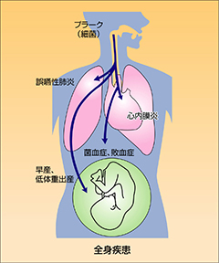 歯周病は全身の健康にも関わりがあります